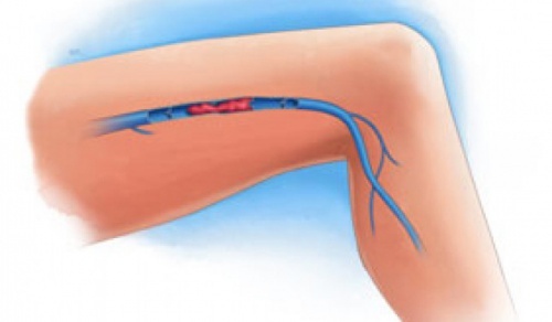 Symptome einer Venenthrombose in den Beinen