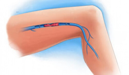 Symptome einer Venenthrombose in den Beinen Symptome einer Venenthrombose in den Beinen