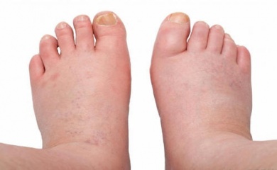 Geschwollene Knöchel und Füße: 6 natürliche Hausmittel