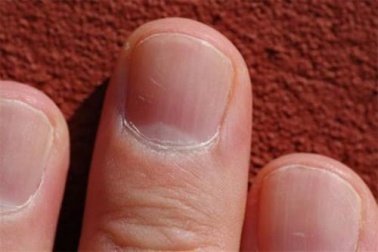 Fingernägel: Was man alles an ihnen ablesen kann