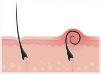 Tipps gegen eingewachsene Haare. Was tun?
