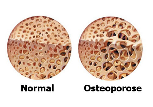 Osteoporosis_-500x350