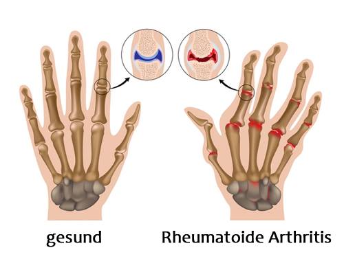 Rheumatoide Arthritis (2)