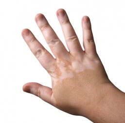 Wenn die Haut weiße Flecken bekommt: Vitiligo