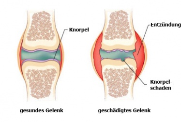 Hausmittel gegen Arthritisschmerzen