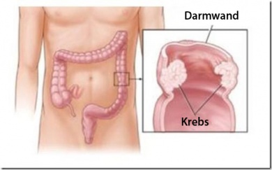 7 Anzeichen für Darmkrebs
