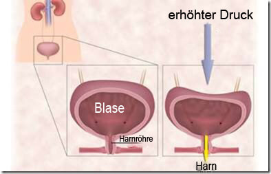 harninkontinenz