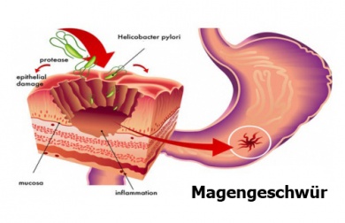 Naturheilmittel gegen Helicobacter Pylori
