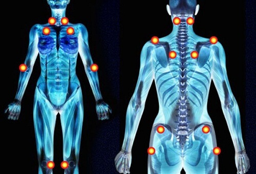 Fibromyalgiepunkte