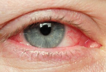 Gesunderhaltung deiner Augen ist wichtig