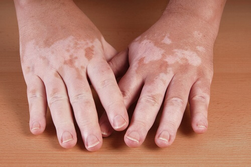 5 Hausmittel gegen Vitiligo 5 Hausmittel gegen Vitiligo