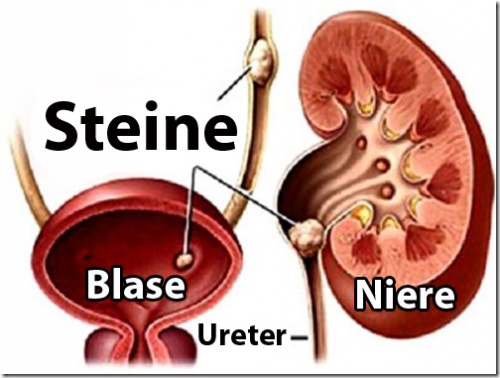 nierensteine