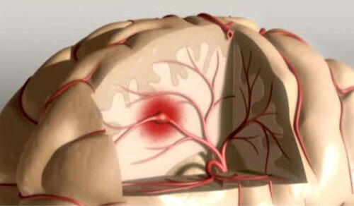 Schlaganfall: Ist Vorsorge oder eine frühzeitige Diagnose möglich? Schlaganfall: Ist Vorsorge oder eine frühzeitige Diagnose möglich?