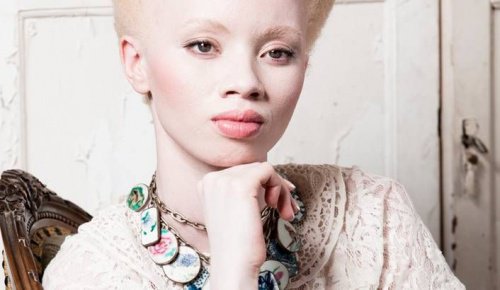 Albinismus: der bewegende Fall des Models Thando Hopa