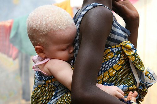 Albinismus-Tansania