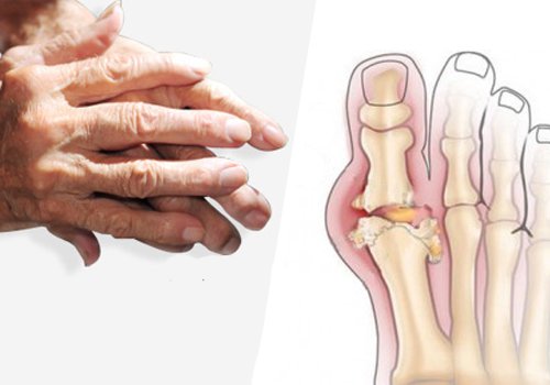 Arthritis