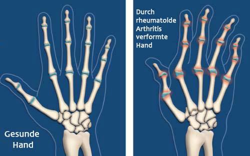 Arthritis-Illustration