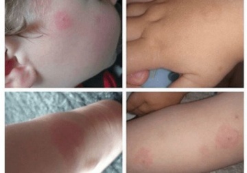 Vorsicht, Zecken! Informationen zu Borreliose und mit dieser Erkrankung verbundenen Risiken