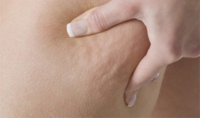 Wie du Cellulite durch Ernährung reduzieren kannst