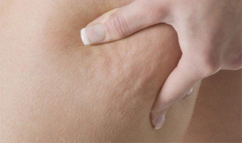 Wie du Cellulite durch Ernährung reduzieren kannst