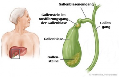 Gallensteine auf natürliche Weise entfernen