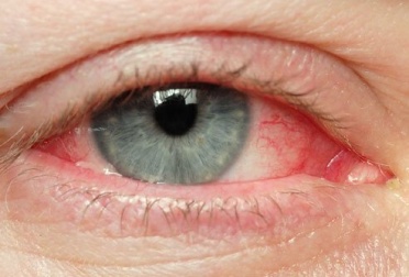 Natürliche Abhilfe gegen gereizte Augen