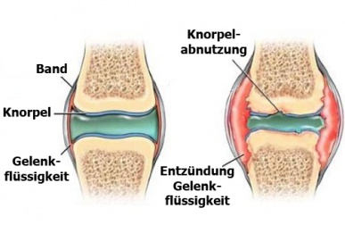 Wie kann man Knorpelschäden vorbeugen?