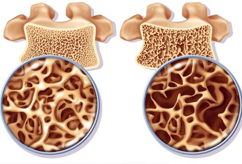 Osteoporose: Übungen zur Prophylaxe und Unterstützung der Therapie