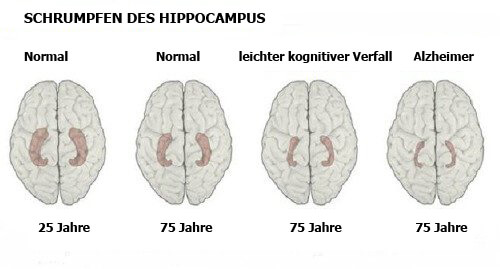 10 wichtige Anzeichen für Alzheimer 10 wichtige Anzeichen für Alzheimer