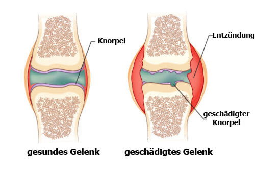 So sieht Arthritis aus