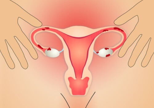 Endometriose: Ursachen und Behandlungen