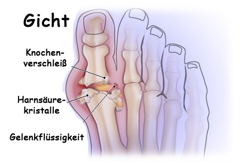 Durch Gicht geschädigter Fuß