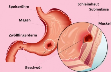 Hausmittel gegen Magengeschwüre