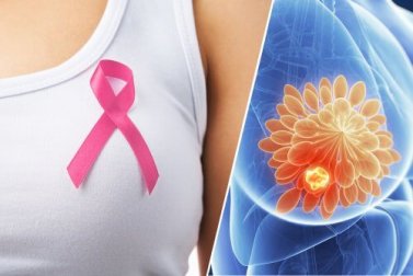 10 Anzeichen, die auf Brustkrebs hinweisen