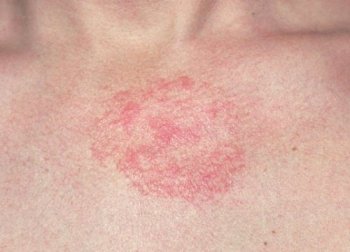 5 Hausmittel gegen Dermatitis