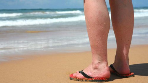 Du hast Krampfadern? 4 Dinge, die du im Sommer vermeiden solltest