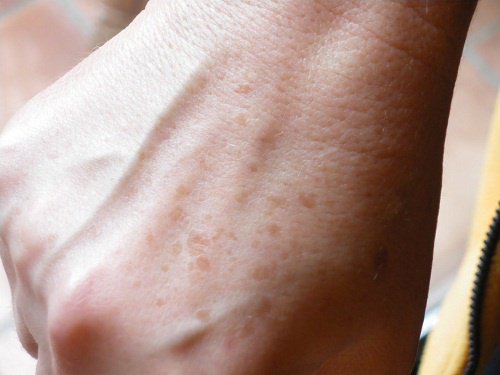 Hausmittel gegen Flecken auf der Haut