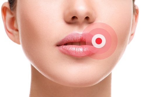 Lippenherpes
