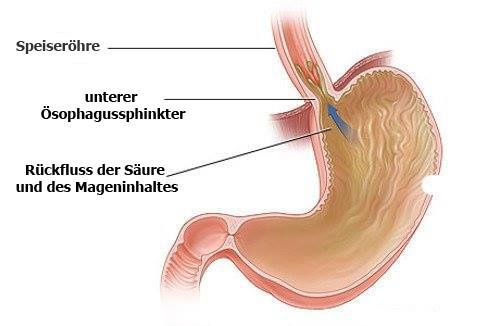 Gastroösophageale Refluxkrankheit