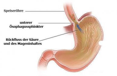 Reflux: Tipps und Tricks mit natürlichen Heilmitteln
