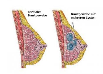 Tipps zur Erkennung und Vorbeugung von Brustzysten