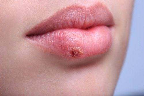 Warum-erscheint-der-Lippenherpes-immer-wieder