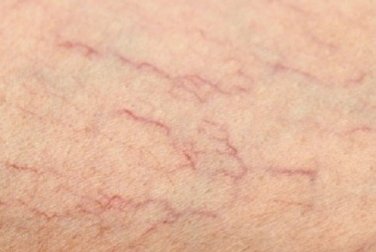 Besenreiser: Helfen Hausmittel bei erweiterten Venen?