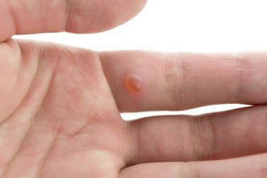 7 Tipps gegen Warzen