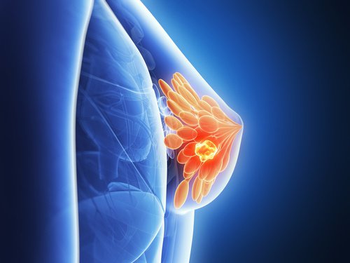 7 Mythen und Wahrheiten zum Thema Brustkrebs 7 Mythen und Wahrheiten zum Thema Brustkrebs