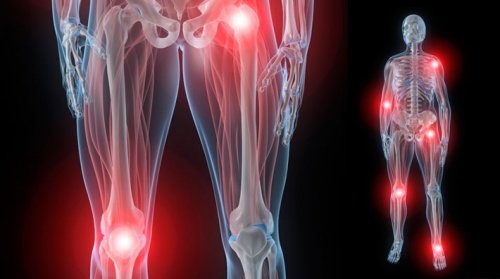 Gelenkschmerzen bei Fibromyalgie