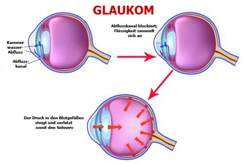 kein Oxymetazolin bei Glaukom