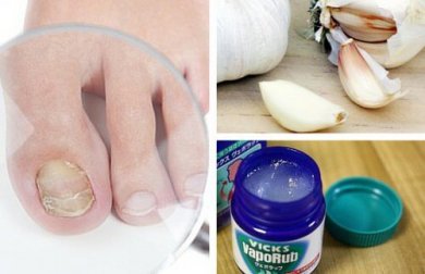 7 Hausmittel gegen Nagelpilz
