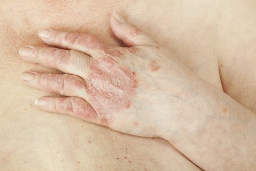 Psoriasis