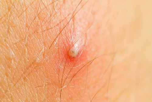 Wie werden eingewachsene Haare vermieden?